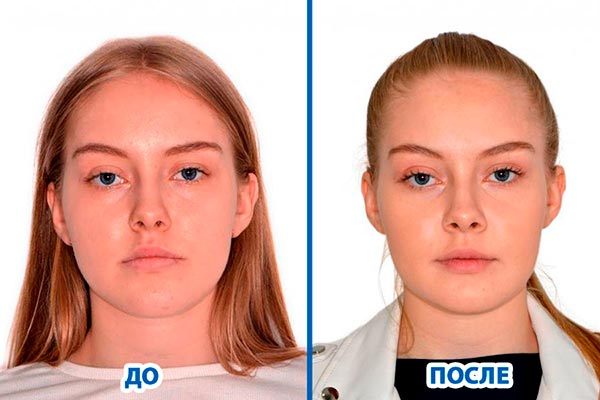 Нужно ли исправлять неправильный прикус?